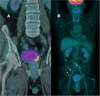 Editorial: New frontiers in “bladder sparing” treatments for high risk NMIBC